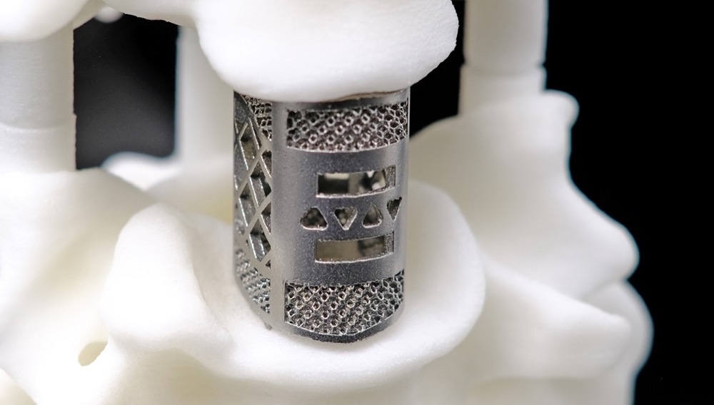 Metal 3d printing in titanium Alloy